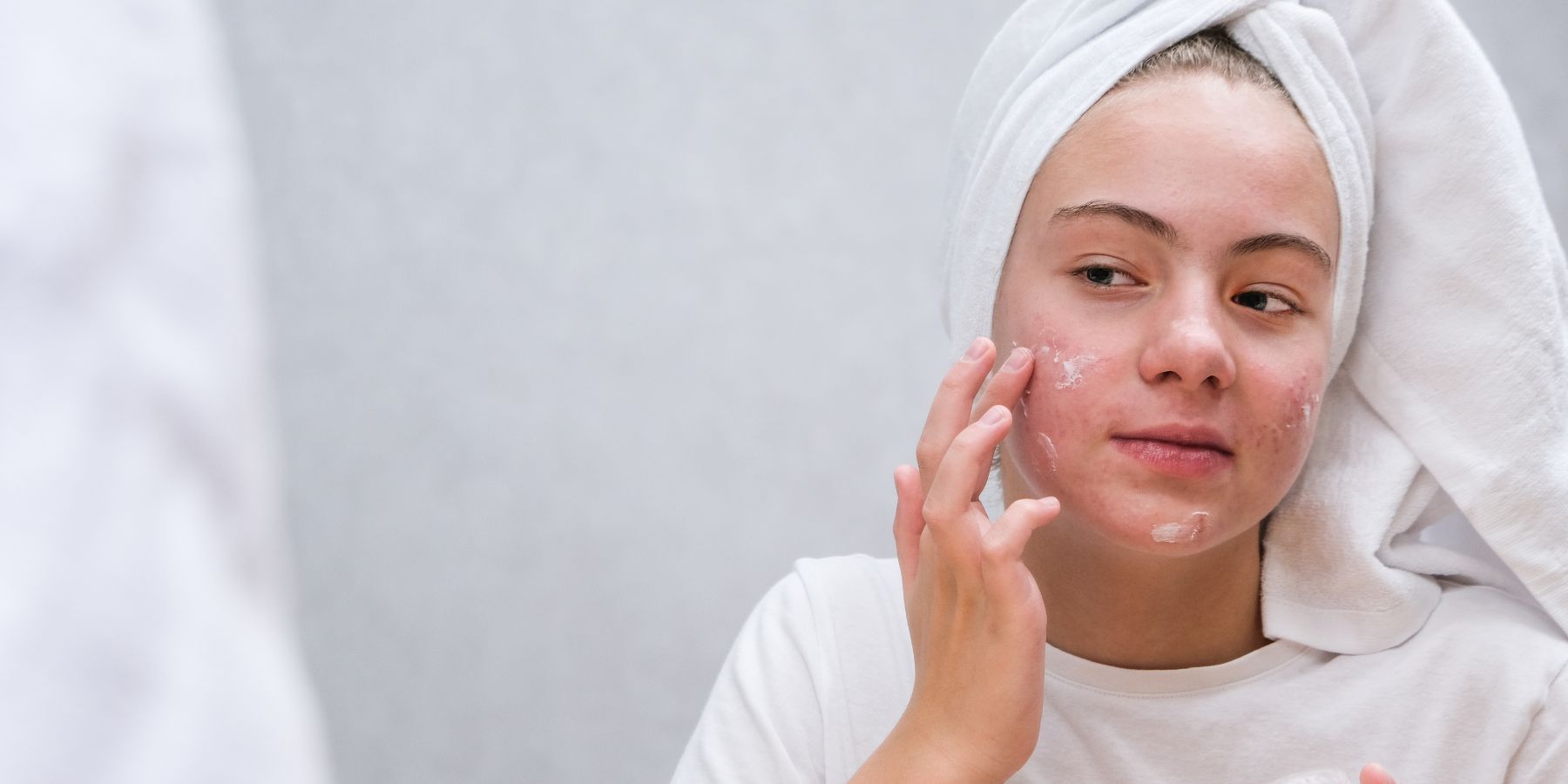 A Comprehensive Guide to Effective Acne Treatments